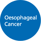 Oesophegeal Cancer